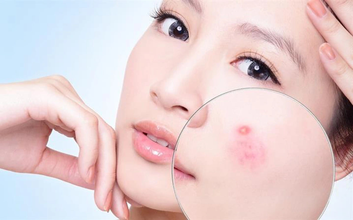 Mụn nhọt sưng đỏ: Nên để tự xẹp hay cần can thiệp?